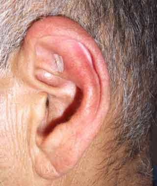 Emagrecimento e técnica complementares - Auriculoterapia e ponto na orelha