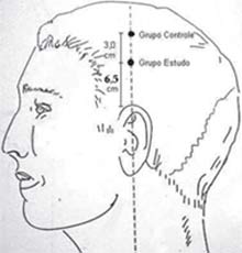 Estudo de acupuntura para zumbido