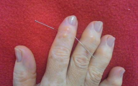 Mão com artrose e acupuntura