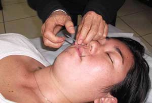 Rinite - Medicina Ocidental e MTC - ponto IG20A