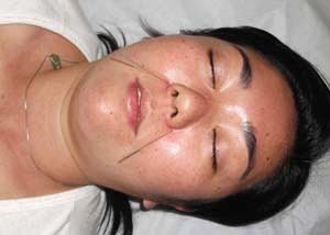 Rinite - Medicina Ocidental e MTC - ponto IG20A