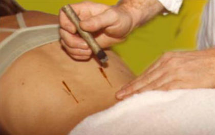 Dor na Coluna e Pontos Jiaji - Moxa